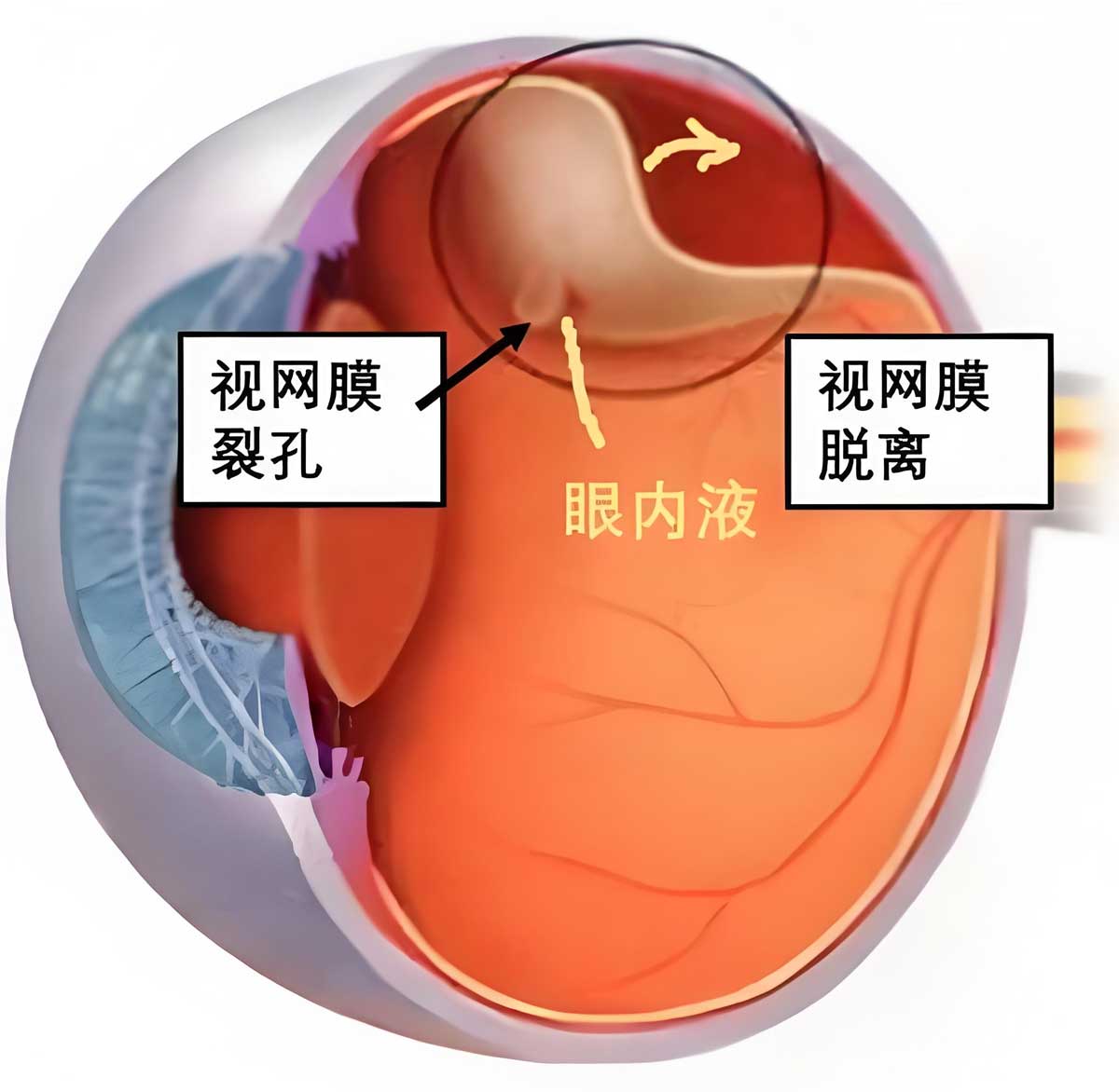 【与时间赛跑 留住光明】曲靖市第二人民医院开通视网膜脱落急诊手术绿色通道